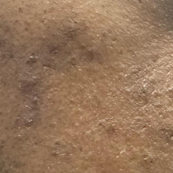 pimples treatment in trichy
