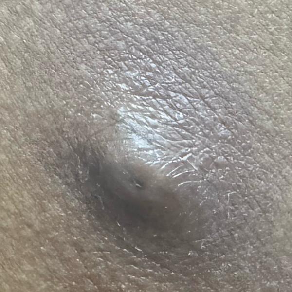 cyst removal in trichy