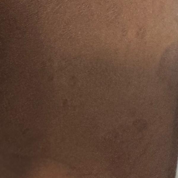 skin doctor trichy fungal infe