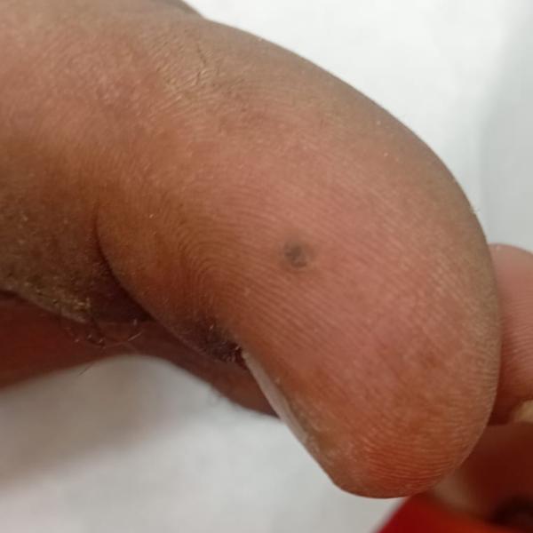 best wart removal in trichy