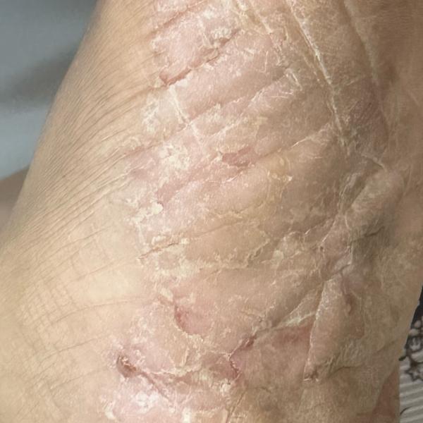 psoriasis treatment in trichy 