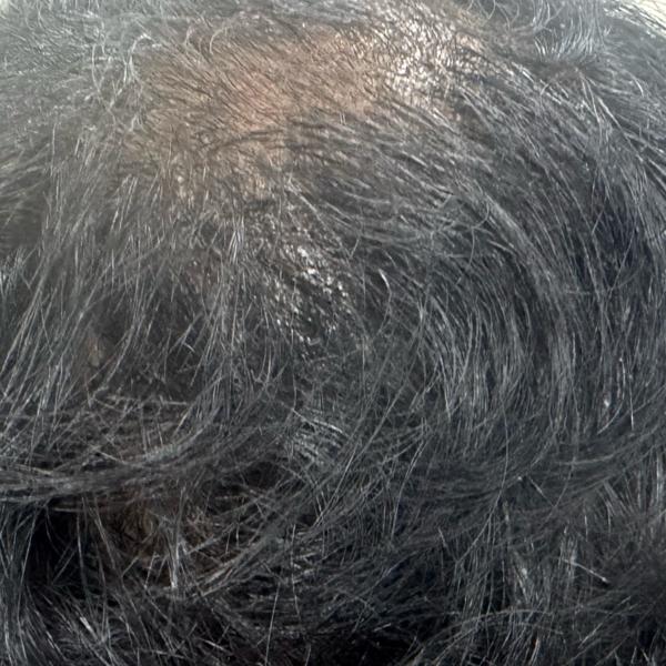 prf treatment in trichy