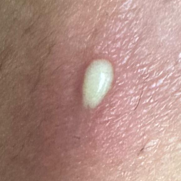 experienced skin infection doc
