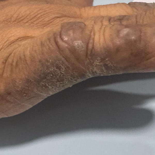 psoriasis treatment in trichy 