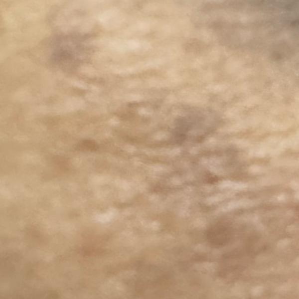 best acne treatment trichy