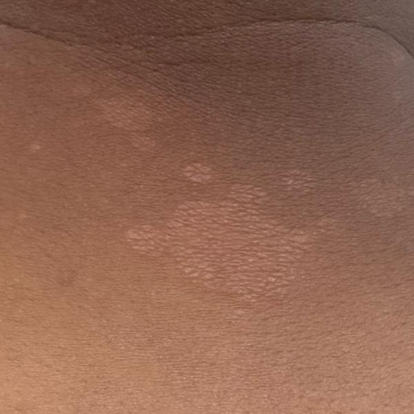 fungal infection doctor in thi