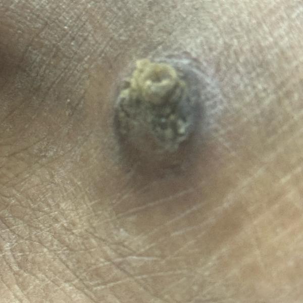 corn removal trichy vitiligo t