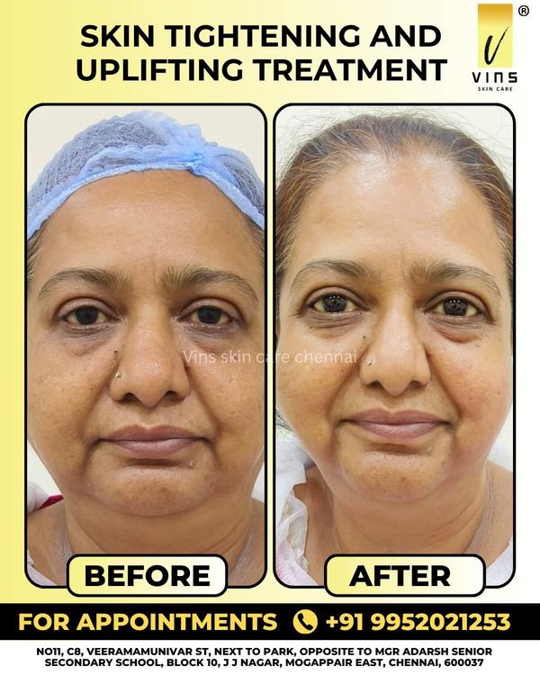 Bring back the youthful glow! ✨
At @vins