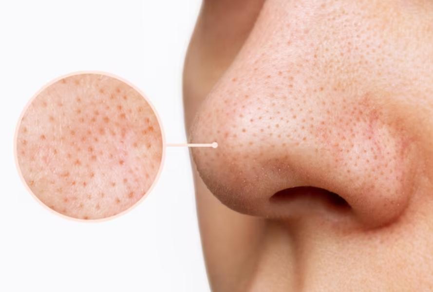 Open pores are a common skin c
