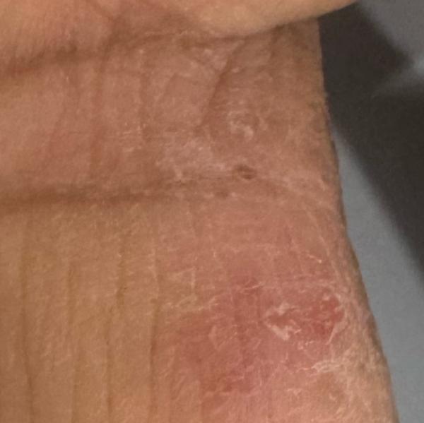 skin doctor trichy psoriasis t
