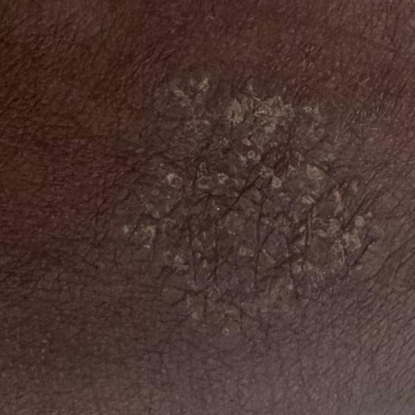 skin doctor trichy fungal infe