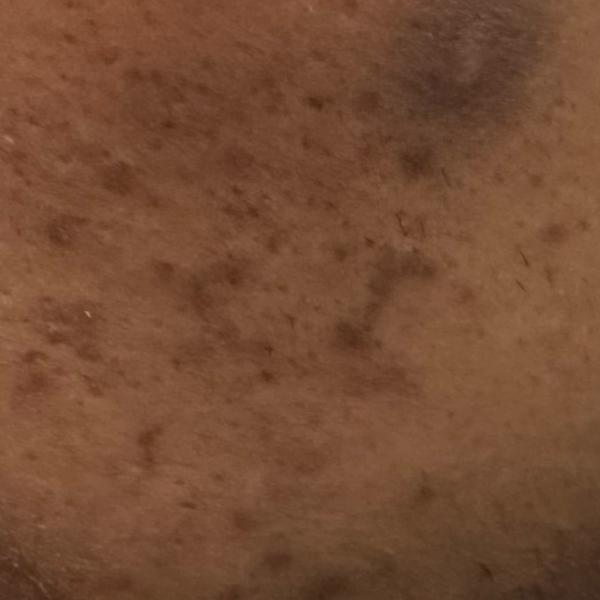 best acne treatment trichy