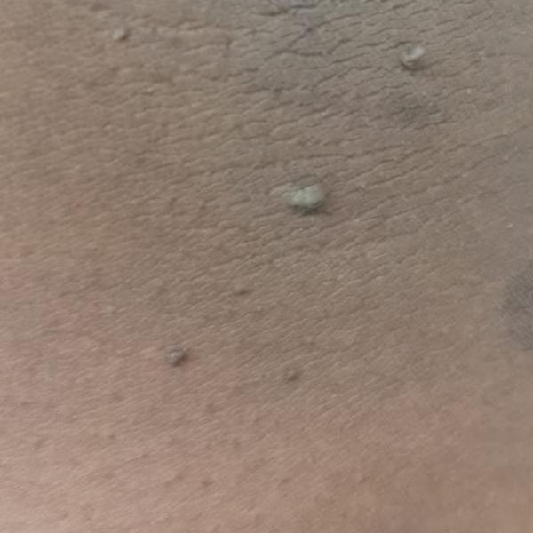 skin tag removal near trichy