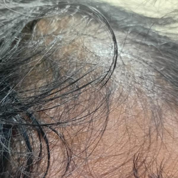 gfc treatment near trichy