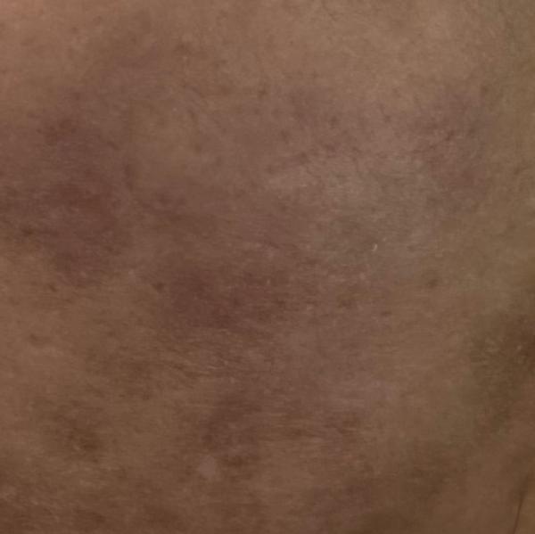 tan removal skin peel