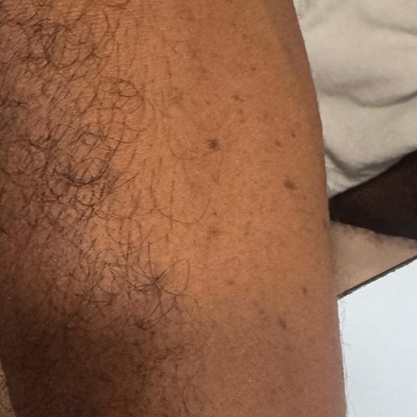 skin doctor trichy psoriasis t