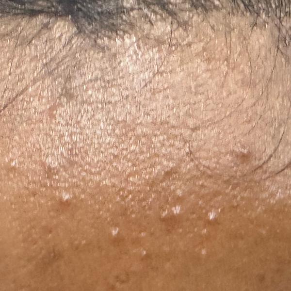 pimples treatment in trichy