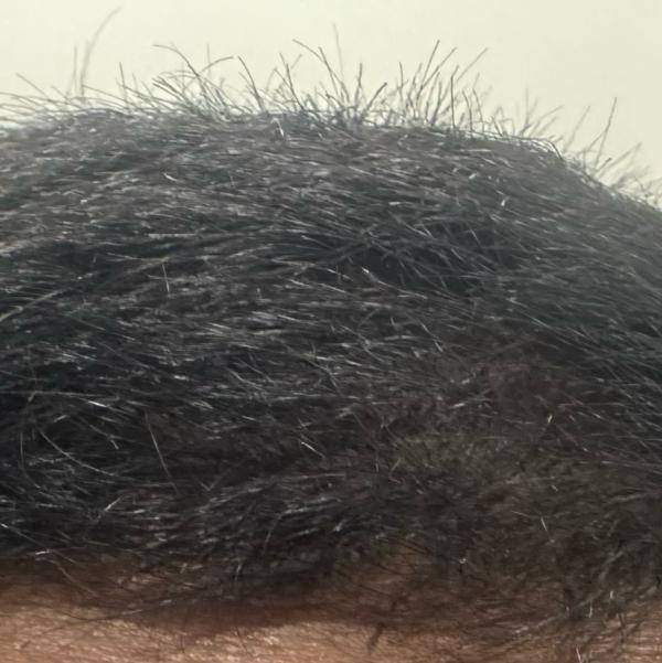 gfc treatment near trichy