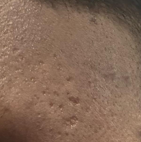 keloid treatment in trichy