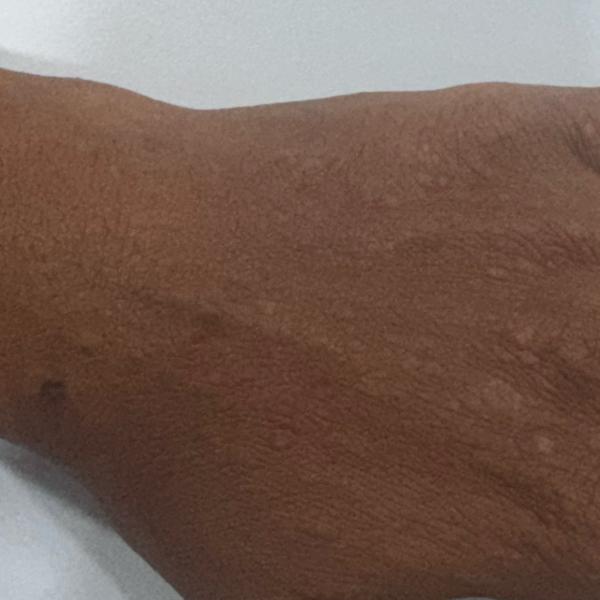 skin allergy and eczema treatm