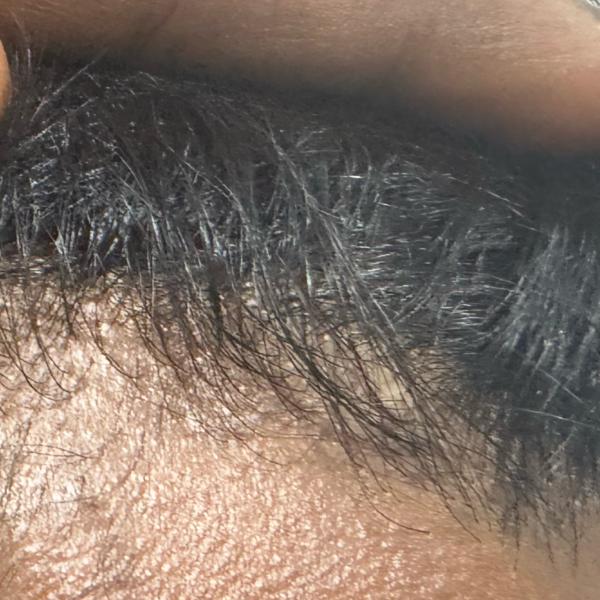 dermatologist for hair fall tr