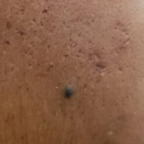 earlobe repair in trichy