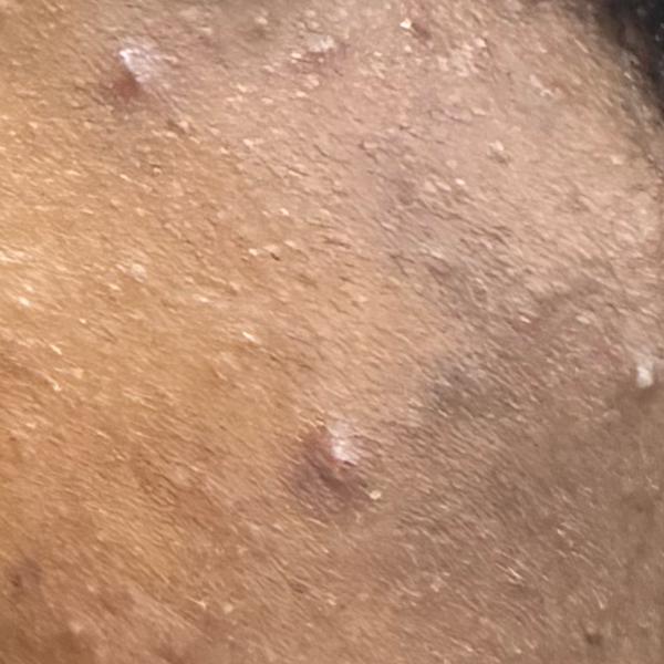 pimples treatment in trichy