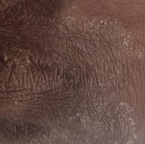 skin doctor trichy fungal infe