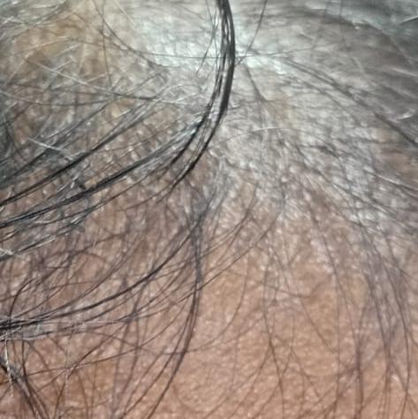 best hair fall treatment in tr