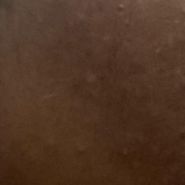 eczema treatment specialist tr