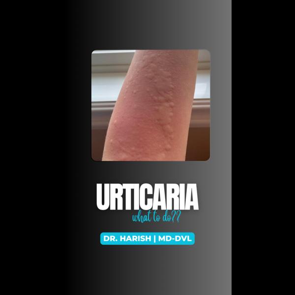Urticaria is a very common ski
