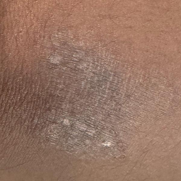 experienced skin infection doc