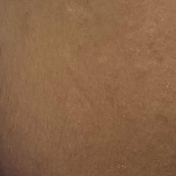 hydra facial expert trichy