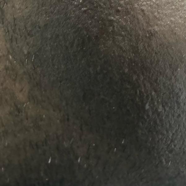 best acne treatment trichy