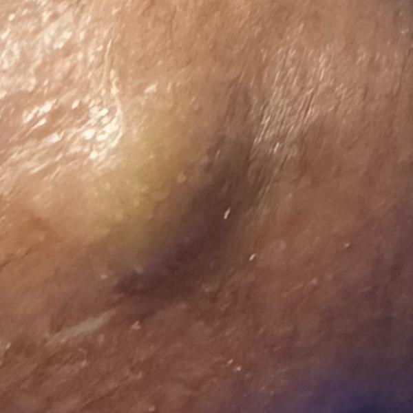 cyst removal in trichy