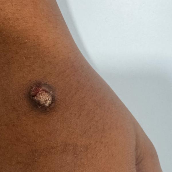 cyst removal in trichy