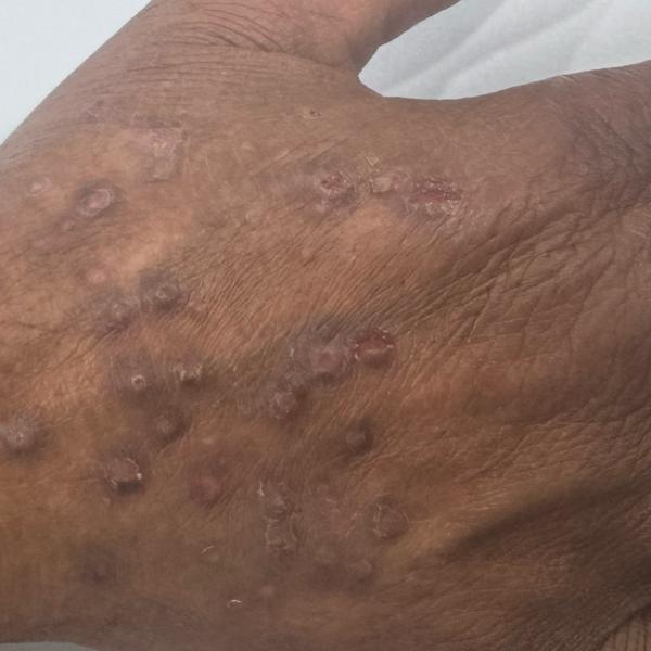 psoriasis treatment in trichy 