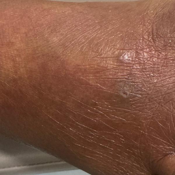 earlobe repair in trichy