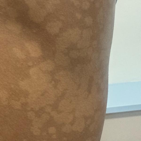 best treatment for fungal infe