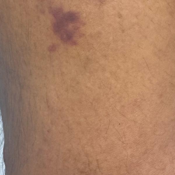skin allergy and eczema treatm