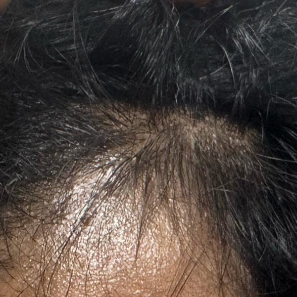 best treatment for hair fall i