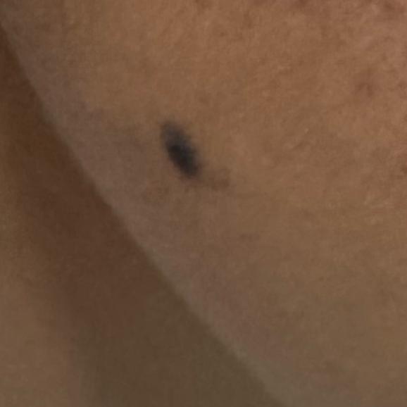 earlobe repair in trichy