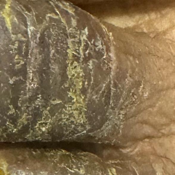best psoriasis treatment in tr
