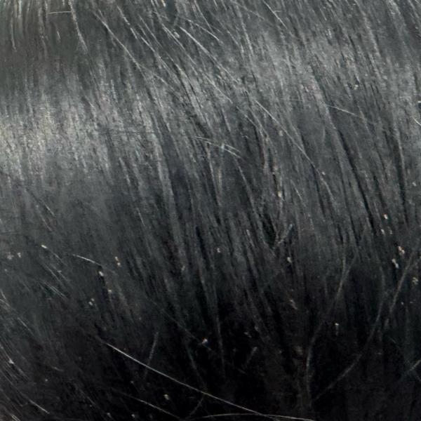 experienced hair fall treatmen
