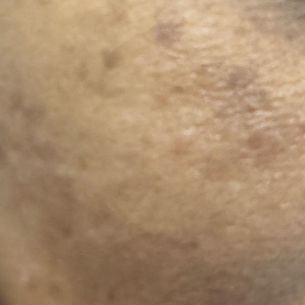 skin peel treatment near me