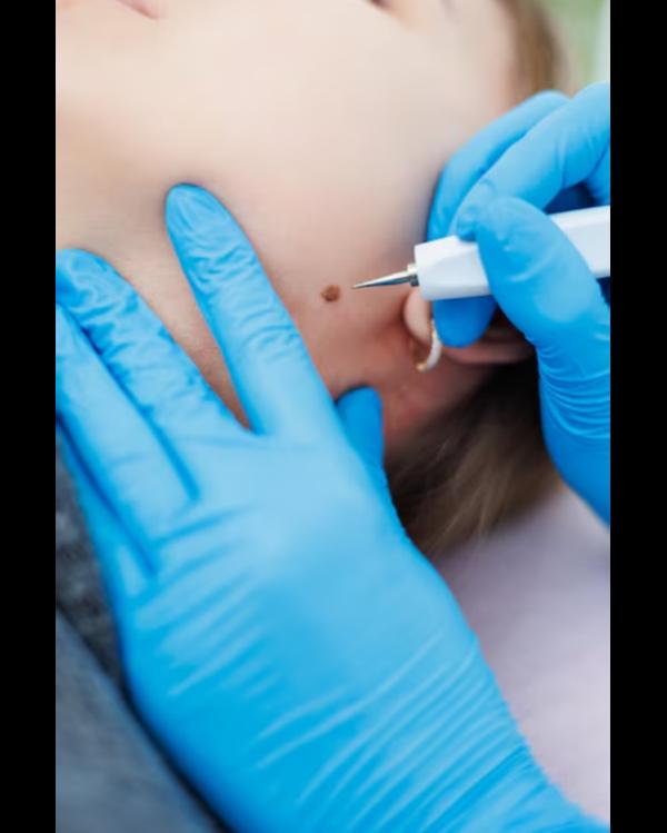 Warts can be an annoying and s