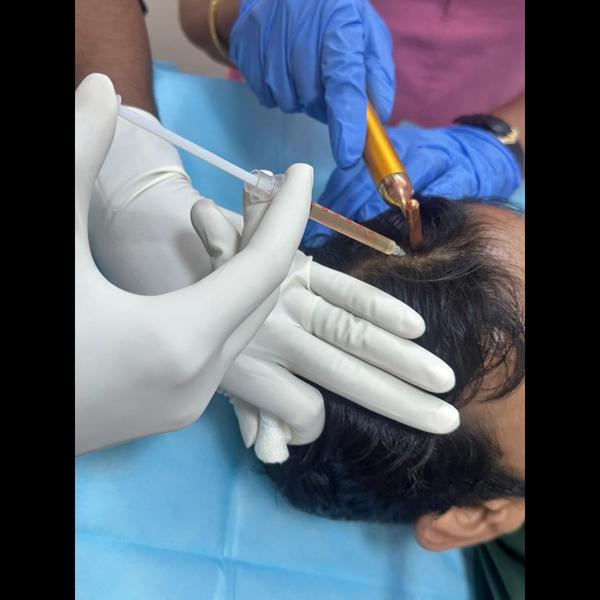 advanced prp hair technology s