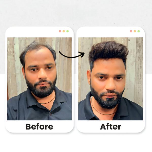 Australian hair patch in Rohin