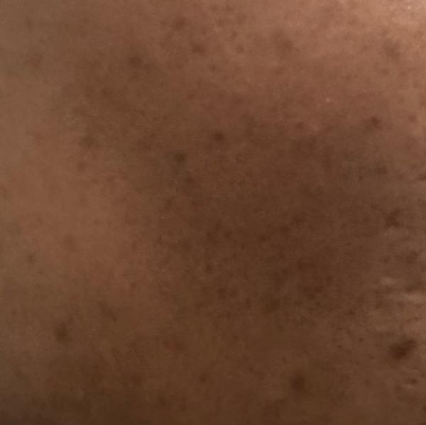 top acne treatment center in t