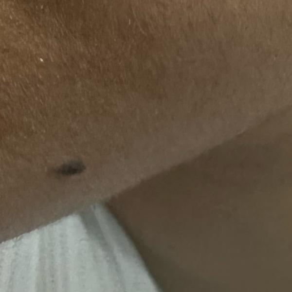 mole removal specialist in tri